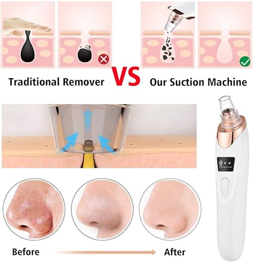 Electric Blackhead Remover