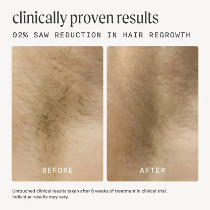 Clinically proven IPL hair removal results showing 92% reduction in hair regrowth with before and after comparison after 8 weeks of Nood treatment