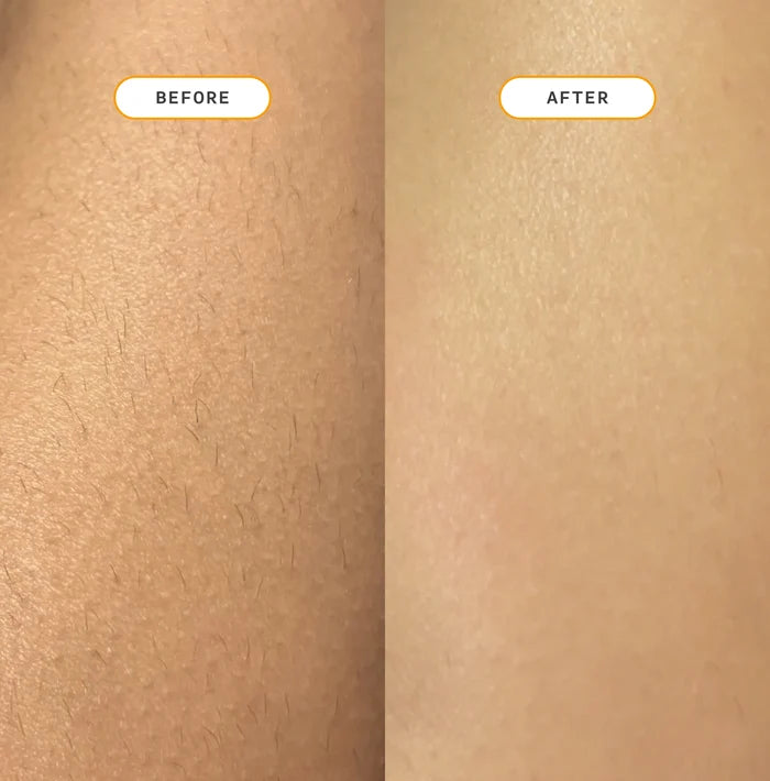 Before and after comparison showing visibly reduced hair growth on skin after using Nood The Eraser