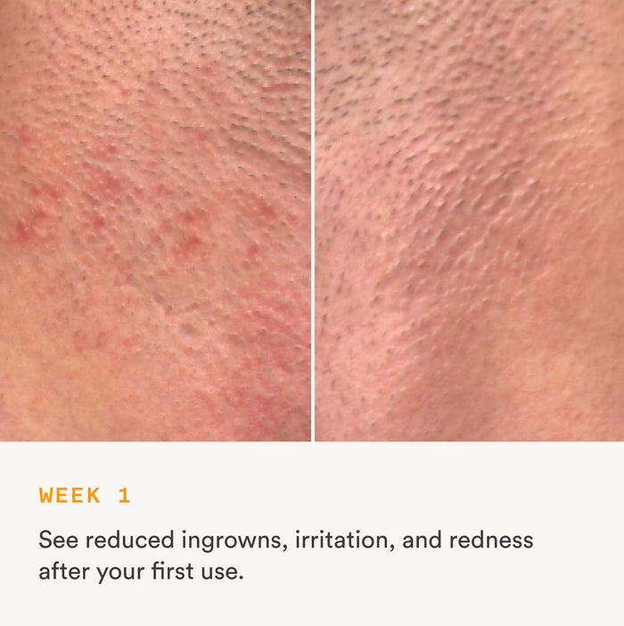 Before and after comparison showing reduced ingrowns, irritation, and redness after one week of using Nood Serum daily aftercare