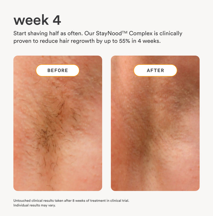 Before and after comparison showing reduced hair regrowth after 4 weeks of using Nood The Nood Serum with StayNood Complex, clinically proven to reduce hair regrowth by up to 55%
