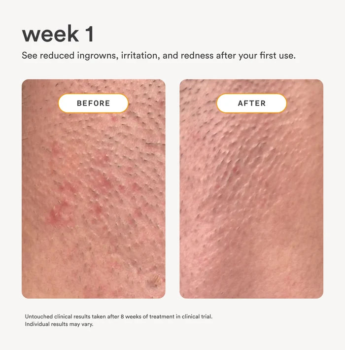 Before and after comparison showing reduced ingrowns, irritation, and redness after week 1 of using Nood Serum daily aftercare